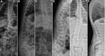 Posterior hemivertebra resection without internal fixation in the treatment of congenital scoliosis in very young children